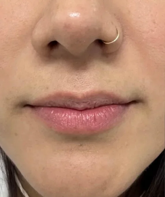 Aumento de labios: antes